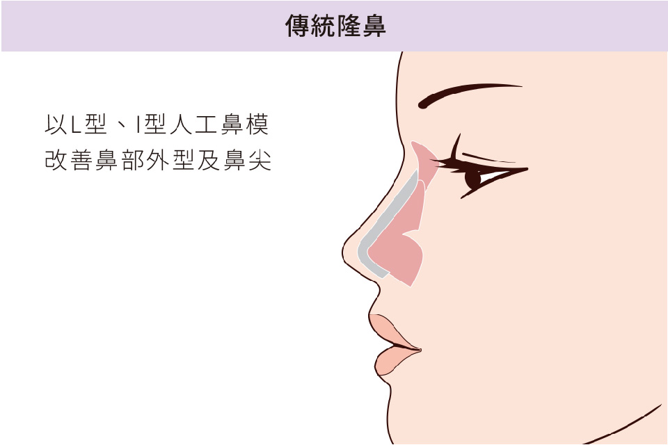 隆鼻推薦-傳統隆鼻