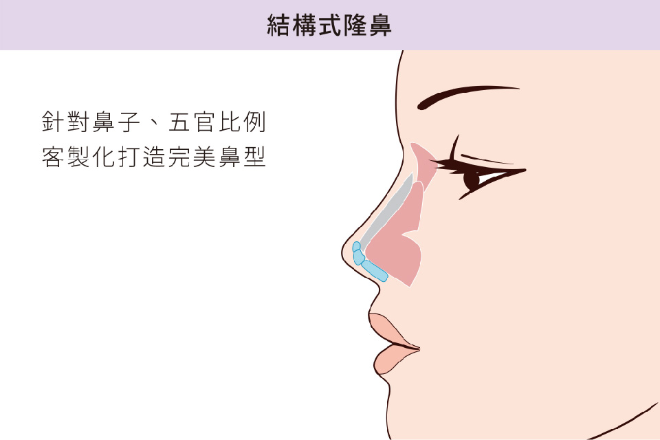 隆鼻推薦-結構式隆鼻