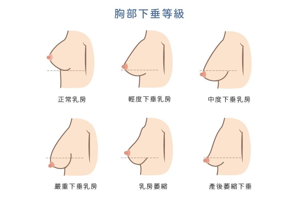 胸部下垂等級