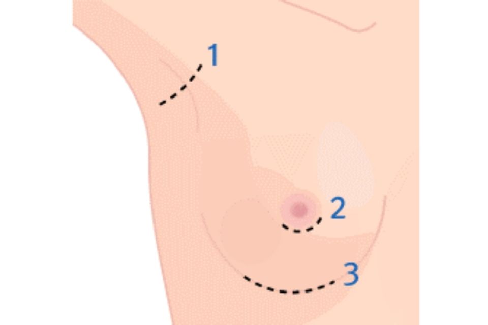 水滴型隆乳的切入口